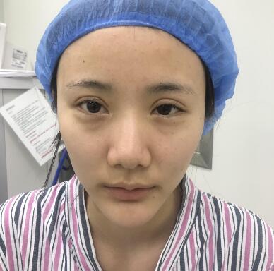 郑州华领医疗江南app官方下载苹果版
医院鼻部整形各种鼻形如何隆鼻，挑医生看案例看些什么