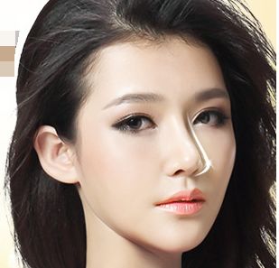 成都忠爱美成医疗江南app官方下载苹果版
：玻尿酸隆鼻手术有什么优势