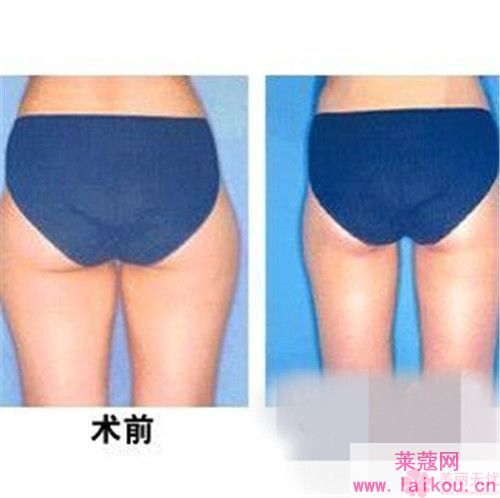 自体组织丰臀的四大作用