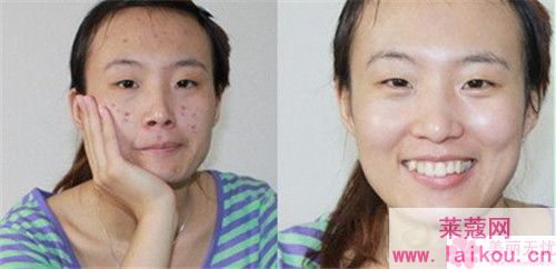 激光磨皮除痘痘效果咋样