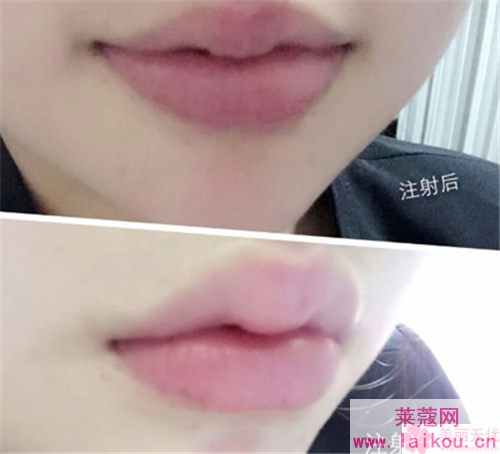 漂唇和纹唇那个比较好