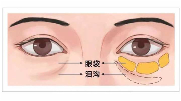 吸脂去眼袋，吸脂去眼袋效果好吗