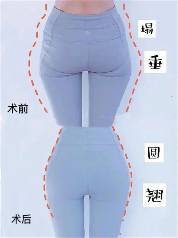 吸脂恢复，吸脂恢复期要多久