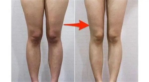 大腿内侧吸脂，大腿内侧吸脂多少钱