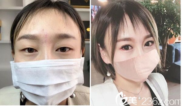 广州下颌角整形哪家医院好